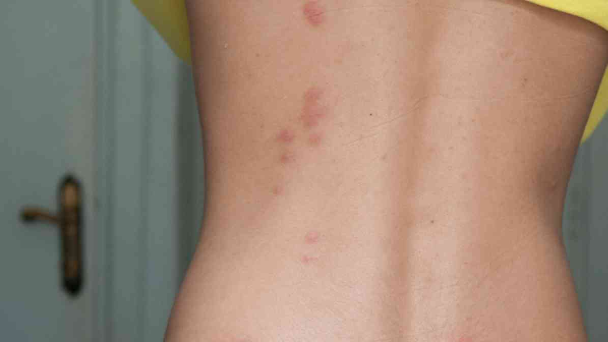 3. Bed Bug Bites Pictures