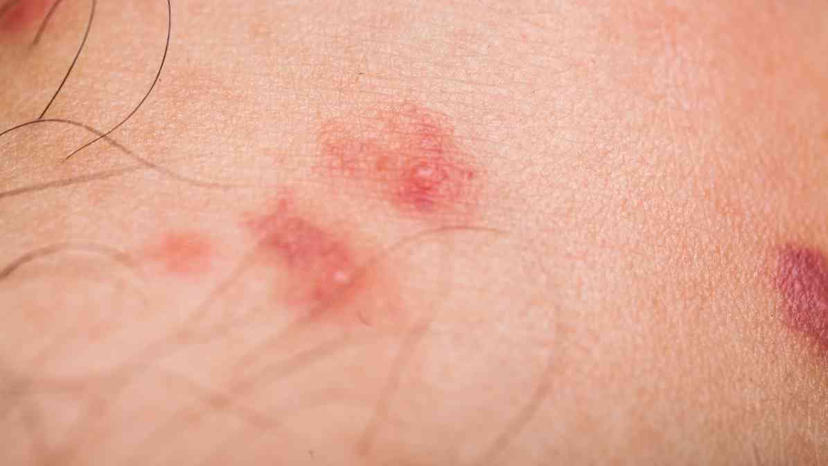 Flea Infestation - Flea Bite Reaction on Human