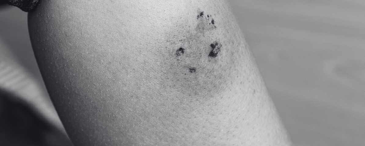 Identifying Spider Bites, Symptoms and Treatment