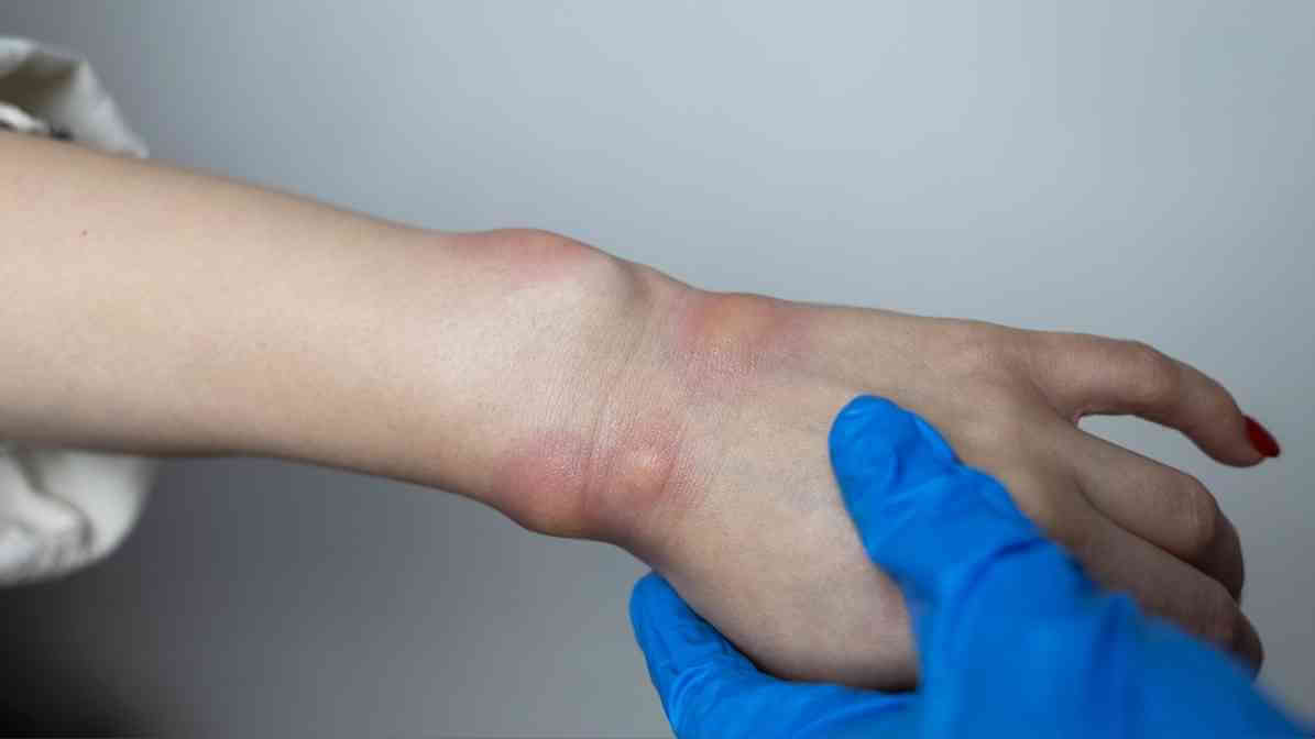 Effective Bees Control in Malaysia - Allergic Reactions | Innovative Pest Sdn Bhd Effective Bees Control in Malaysia - Allergic Reactions